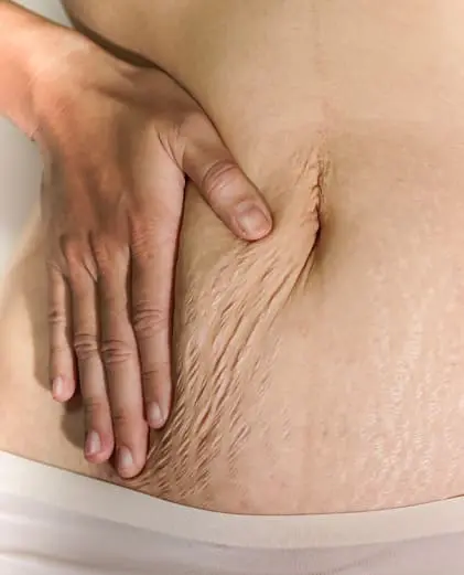 dr-grace-kelly-your-conditions-body-stretch-marks-featured