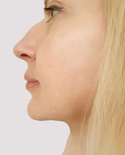 dr-grace-kelly-your-conditions-face-bump-on-the-nose-featured