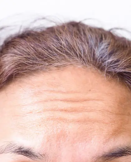 dr-grace-kelly-your-conditions-face-forehead-lines-featured
