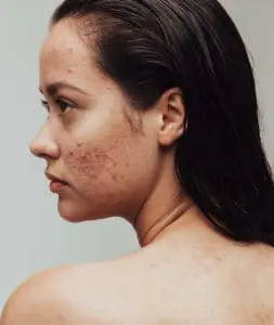 Acne Treatments