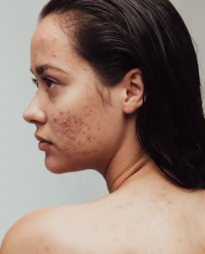 dr-grace-kelly-your-conditions-skin-acne-featured