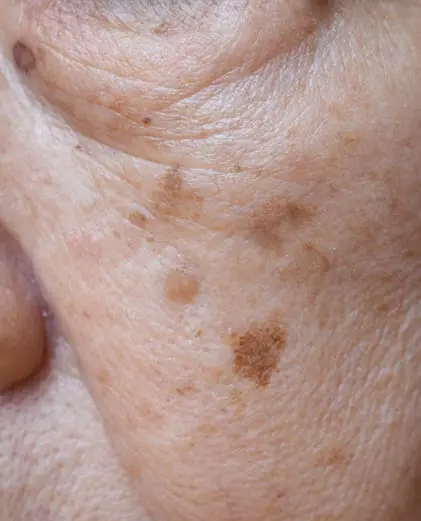 dr-grace-kelly-your-conditions-skin-age-spots-featured