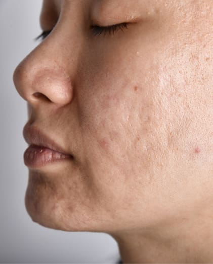 dr-grace-kelly-your-conditions-skin-acne-scarring-featured
