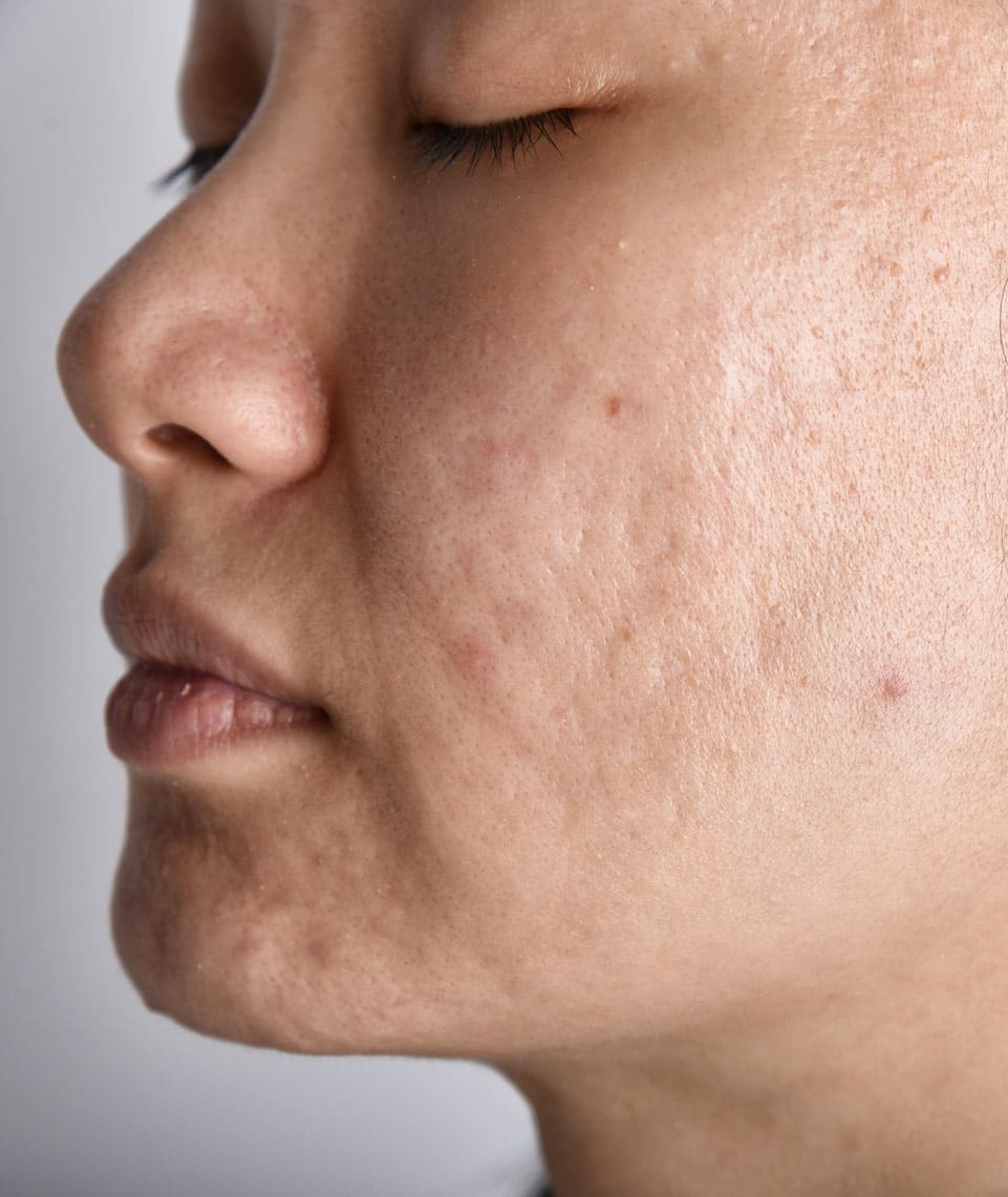 dr-grace-kelly-your-conditions-skin-acne-scarring