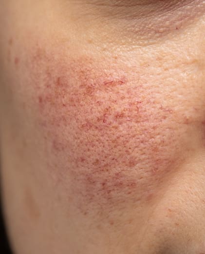 Rosacea treatment in Beaconsfield