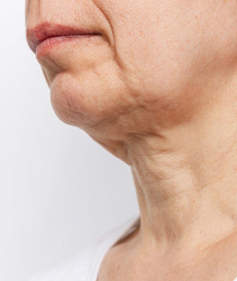 The Top 5 Non Surgical Treatments For Neck Rejuvenation 3194