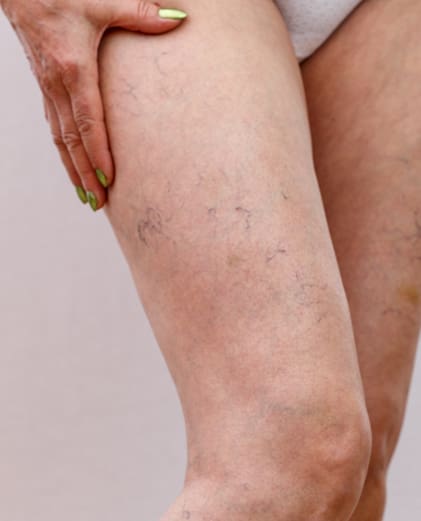 dr-grace-kelly-your-conditions-skin-spider-veins-featured
