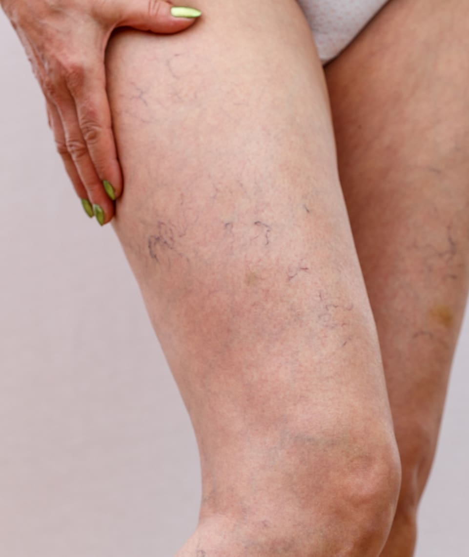 dr-grace-kelly-your-conditions-skin-spider-veins